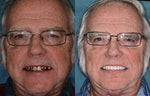 Custom Full Dentures – Genuine Ivory and White Smile
