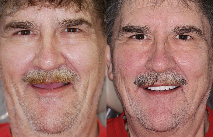 Custom Full Dentures – Genuine Ivory and White Smile