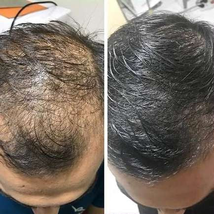 Natural Hair Growth Shampoo | Buy One, Get One Free