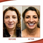Silicone Dental Prosthetics for a Comfortable, Natural Appearance