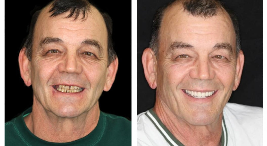 Custom Full Dentures – Genuine Ivory and White Smile