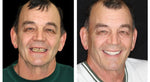 Custom Full Dentures – Genuine Ivory and White Smile