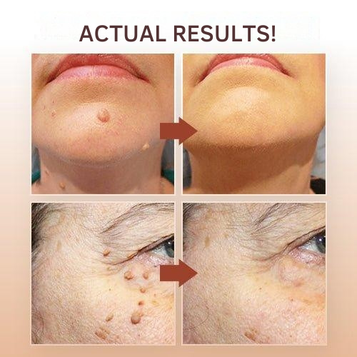 Wart Remover | Precision Applicator for Targeted Treatment | Plant-Based Care Formula