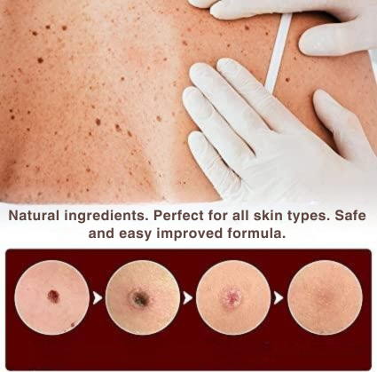 Wart Remover | Precision Applicator for Targeted Treatment | Plant-Based Care Formula