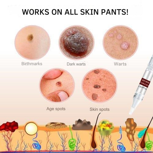 Wart Remover | Precision Applicator for Targeted Treatment | Plant-Based Care Formula
