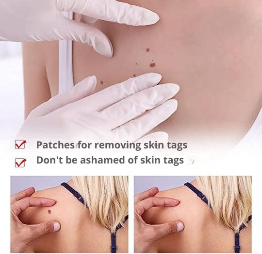 Wart Remover | Precision Applicator for Targeted Treatment | Plant-Based Care Formula
