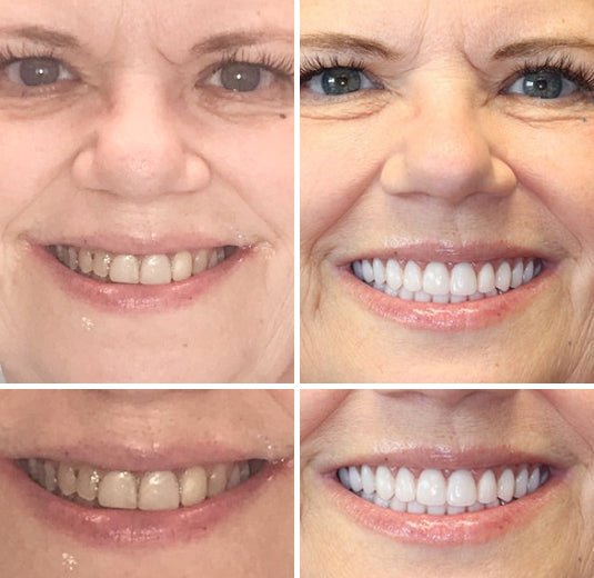 Custom Full Dentures – Genuine Ivory and White Smile