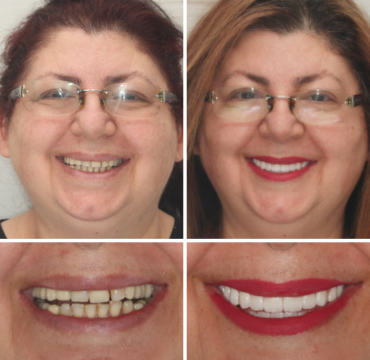 Custom Full Dentures – Genuine Ivory and White Smile
