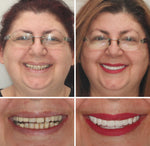 Custom Full Dentures – Genuine Ivory and White Smile