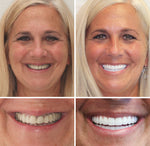 Custom Full Dentures – Genuine Ivory and White Smile