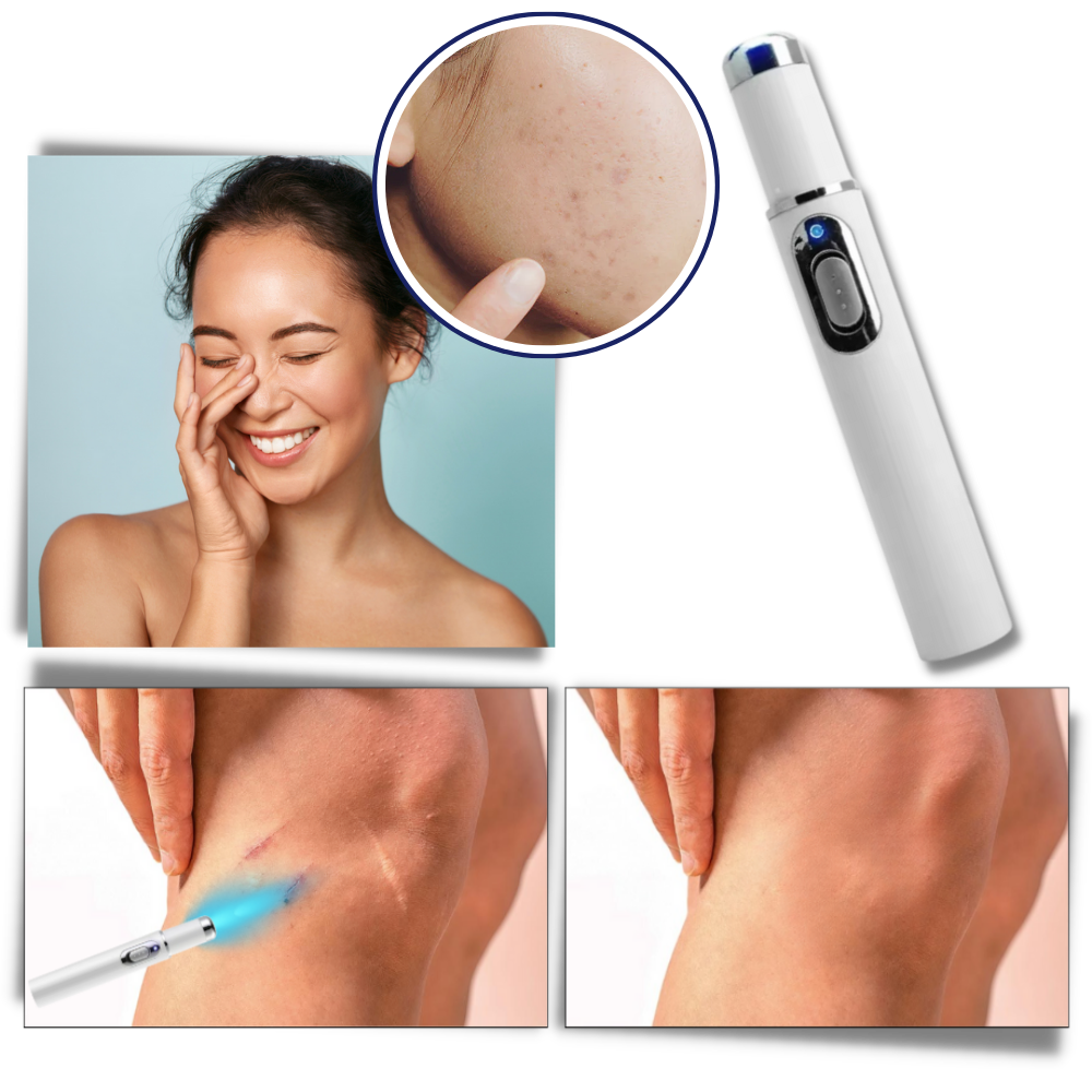 Compact Skin Laser Device for Scar and Discoloration Treatment