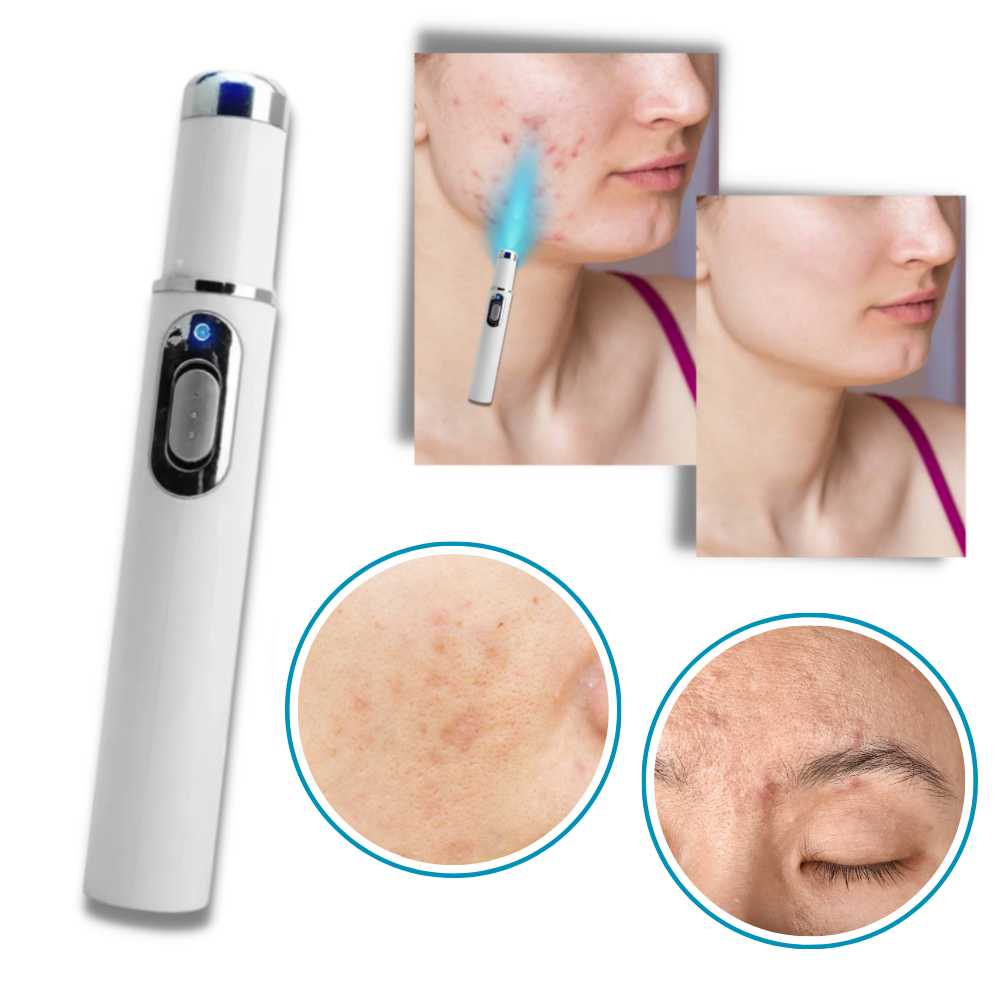 Compact Skin Laser Device for Scar and Discoloration Treatment